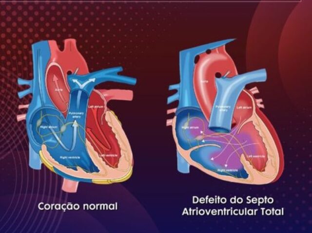 Defeito do Septo Atrioventricular (DSAV): Entenda as Causas e ...